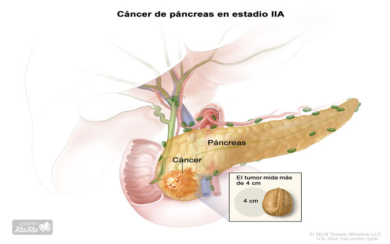 علائم سرطان پانکراس