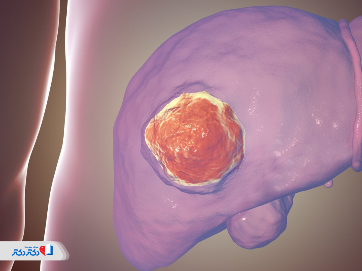 تشخیص تومور کبد در سونوگرافی کبد