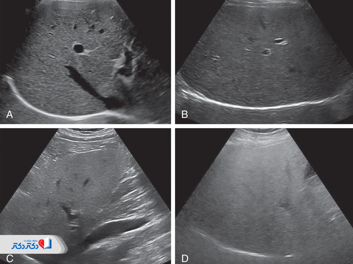 سونوگرافی کبد چرب گرید