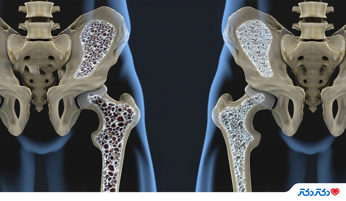 پوکی استخوان osteoporosis