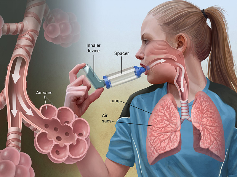 معرفی کامل بیماری آسم