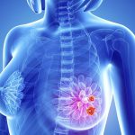 علائم سرطان سینه و روش‌های تشخیص آن