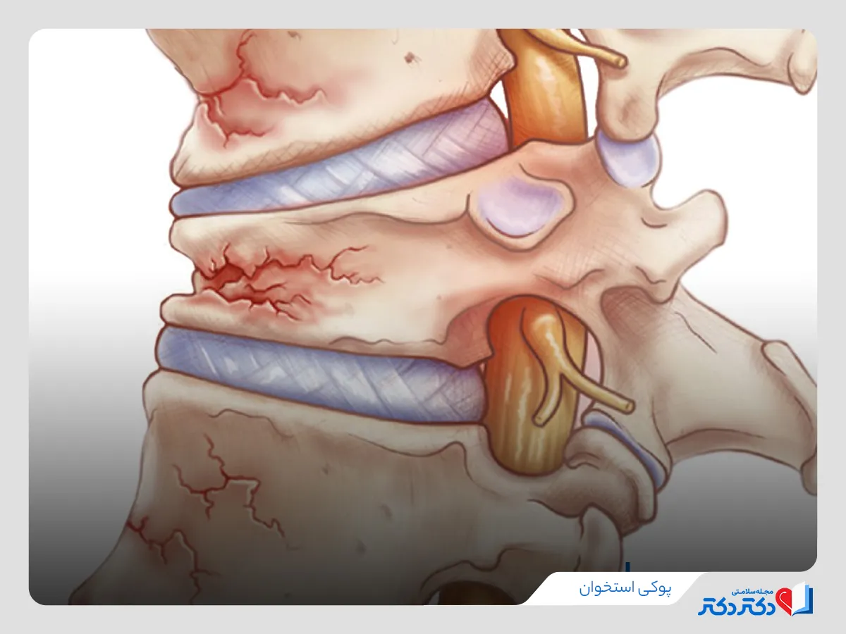 پوکی استخوان چیست