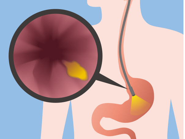 ازوفاگوسکوپی (Esophagoscopy)