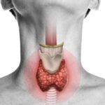 11 مورد از بیماری‌های تیروئید و درمان‌های متداول آن‌ها
