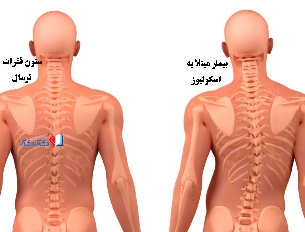 علائم اسکولیوز به چه شکل است؟