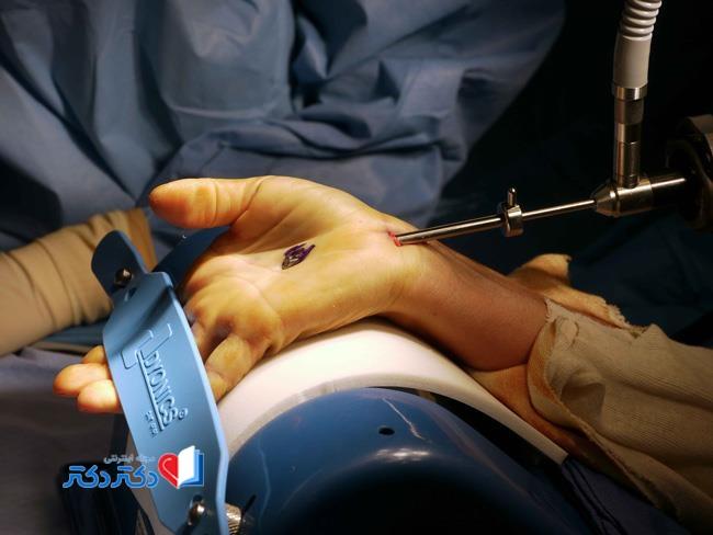 جراحی سندروم تونل کارپال با آندوسکوپی