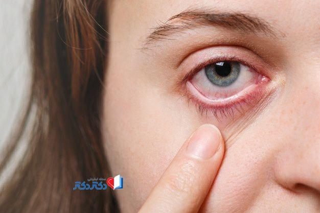 انواع آلرژی چشم
