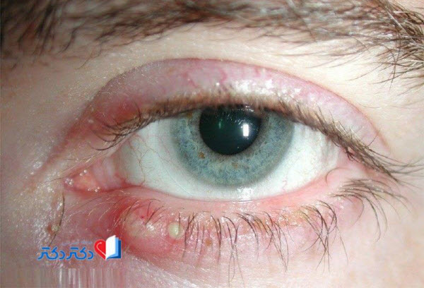 عوارض التهاب چشم