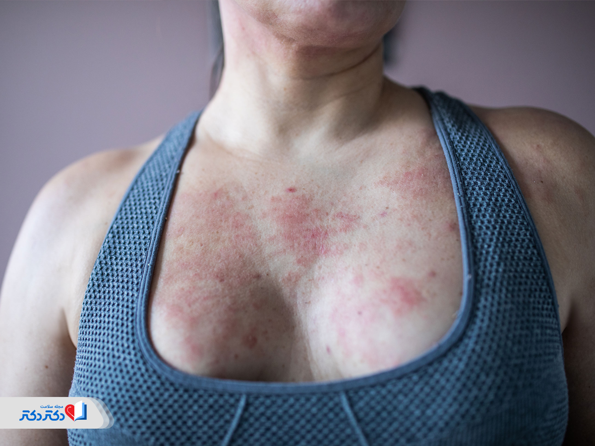 خارش و سوزش سینه