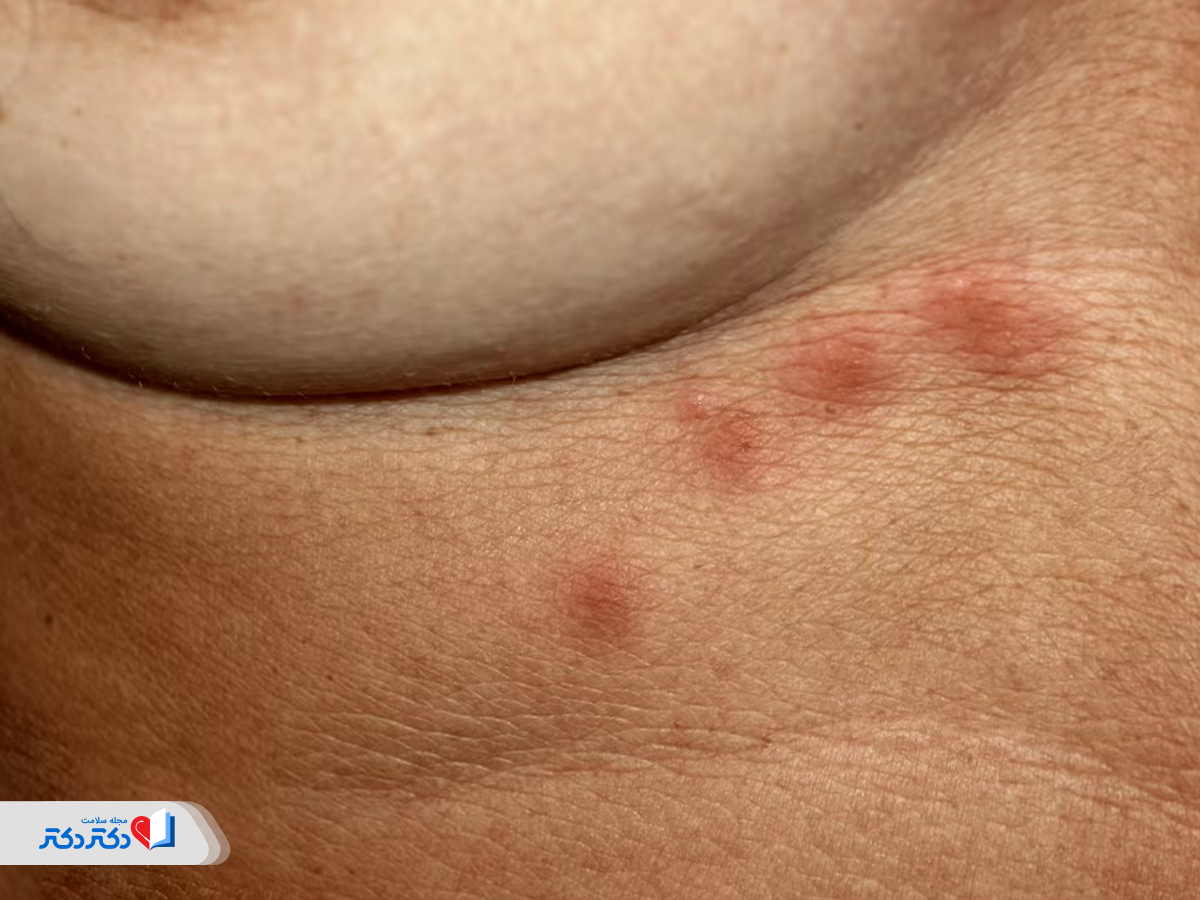 درماتیت تماسی در نواحی سینه