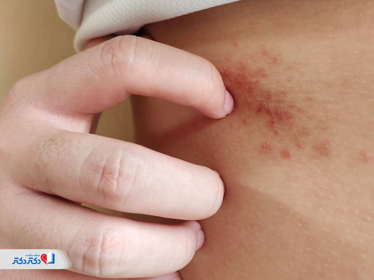علت خارش سینه 