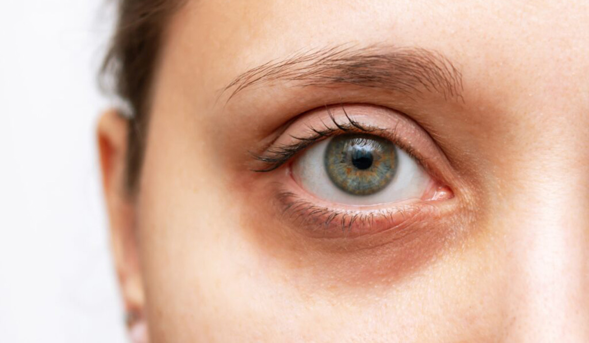 علت سیاهی دور چشم چیست ؛ راه‌های درمان آن