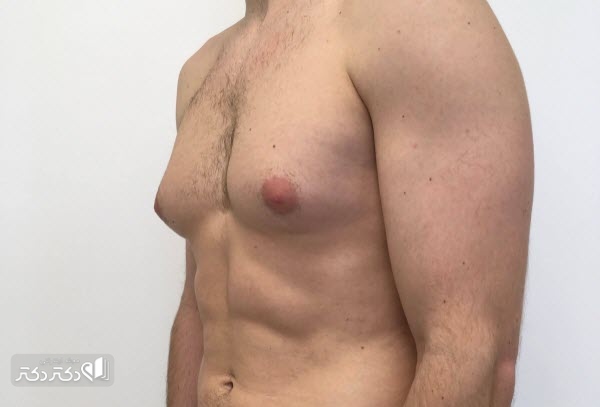 دلیل به وجود آمدن ژنیکوماستی