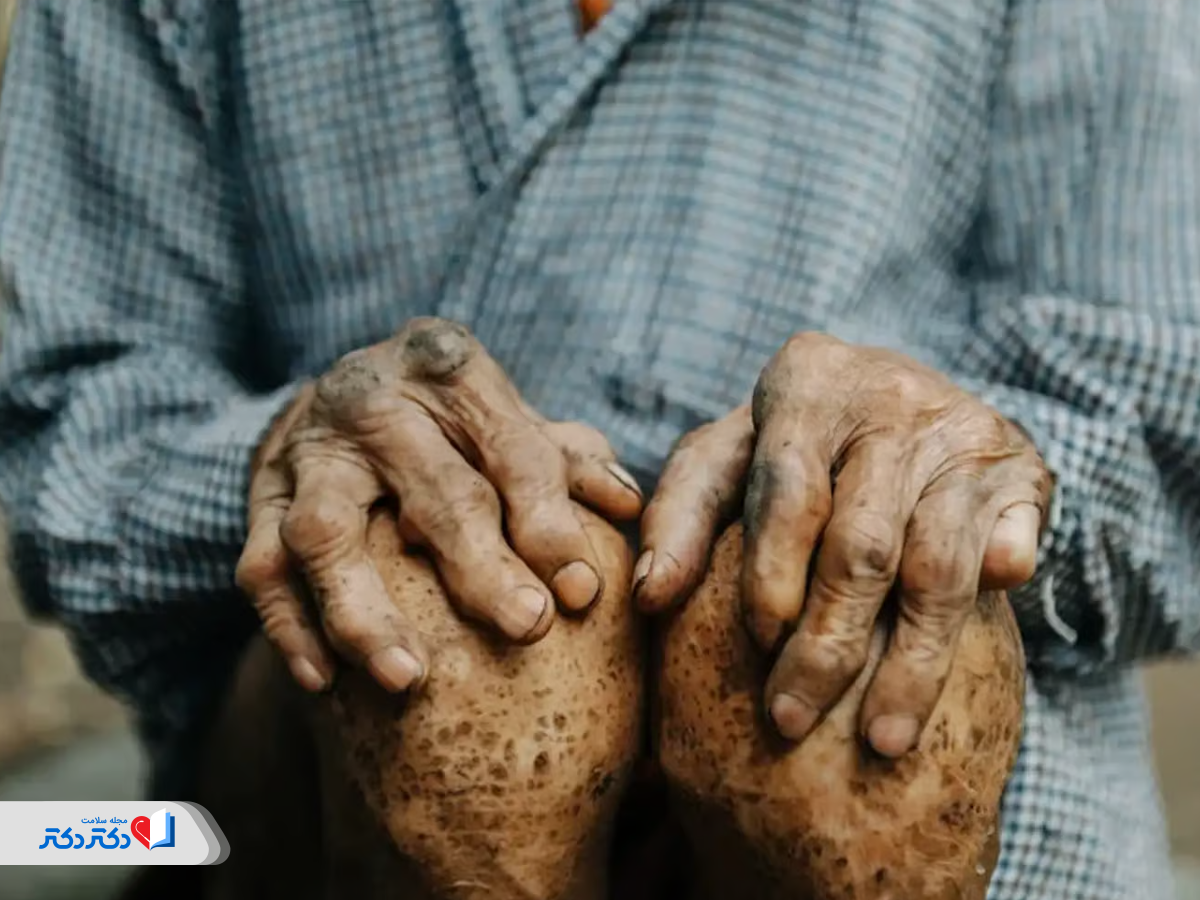 همه‌چیز درباره بیماری جذام