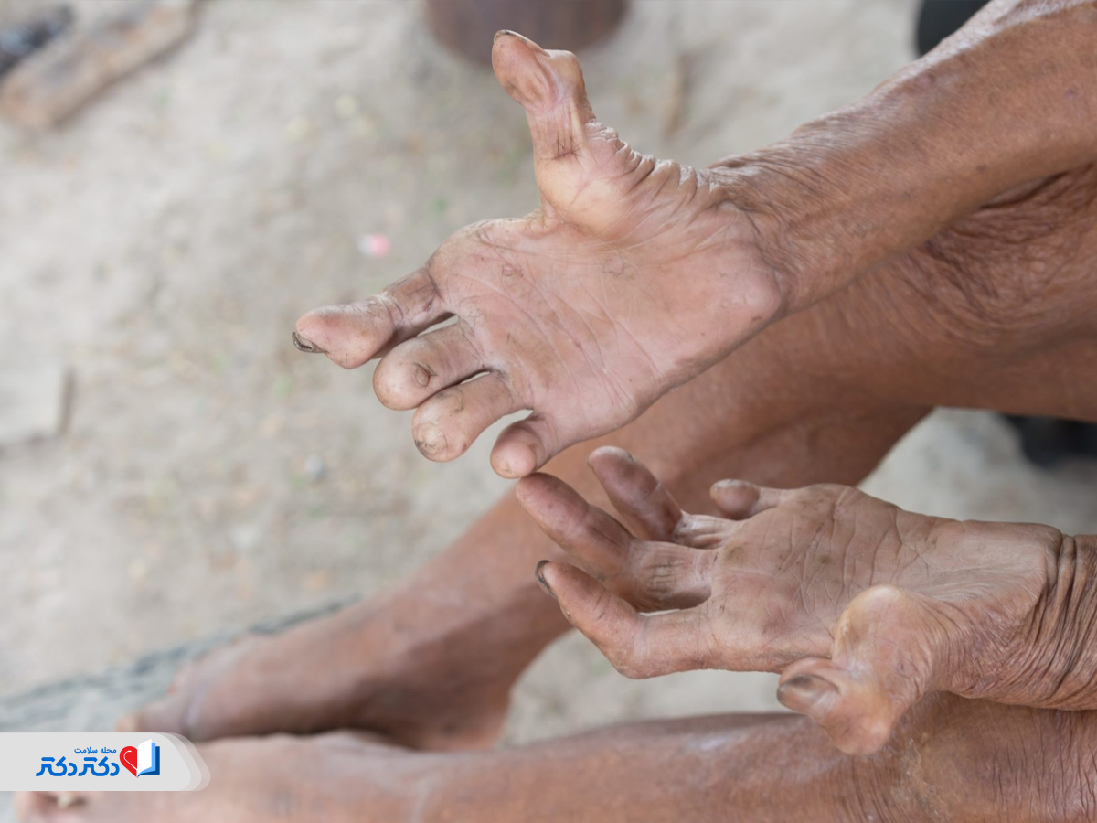 بیماری جذام از بیماری‌های عفونی