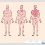 سندروم استیون جانسون چیست؟ + علت، علائم و درمان بیماری استیون جانسون