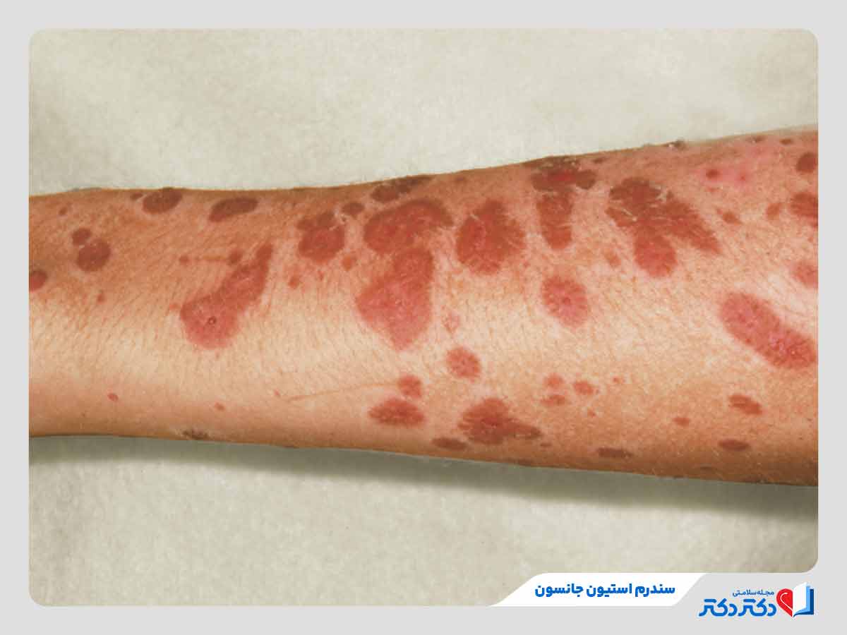 فرد مبتلا به لکهها و تاولهای قرمز یا بنفشرنگ به دلیل سندروم استیون جانسون