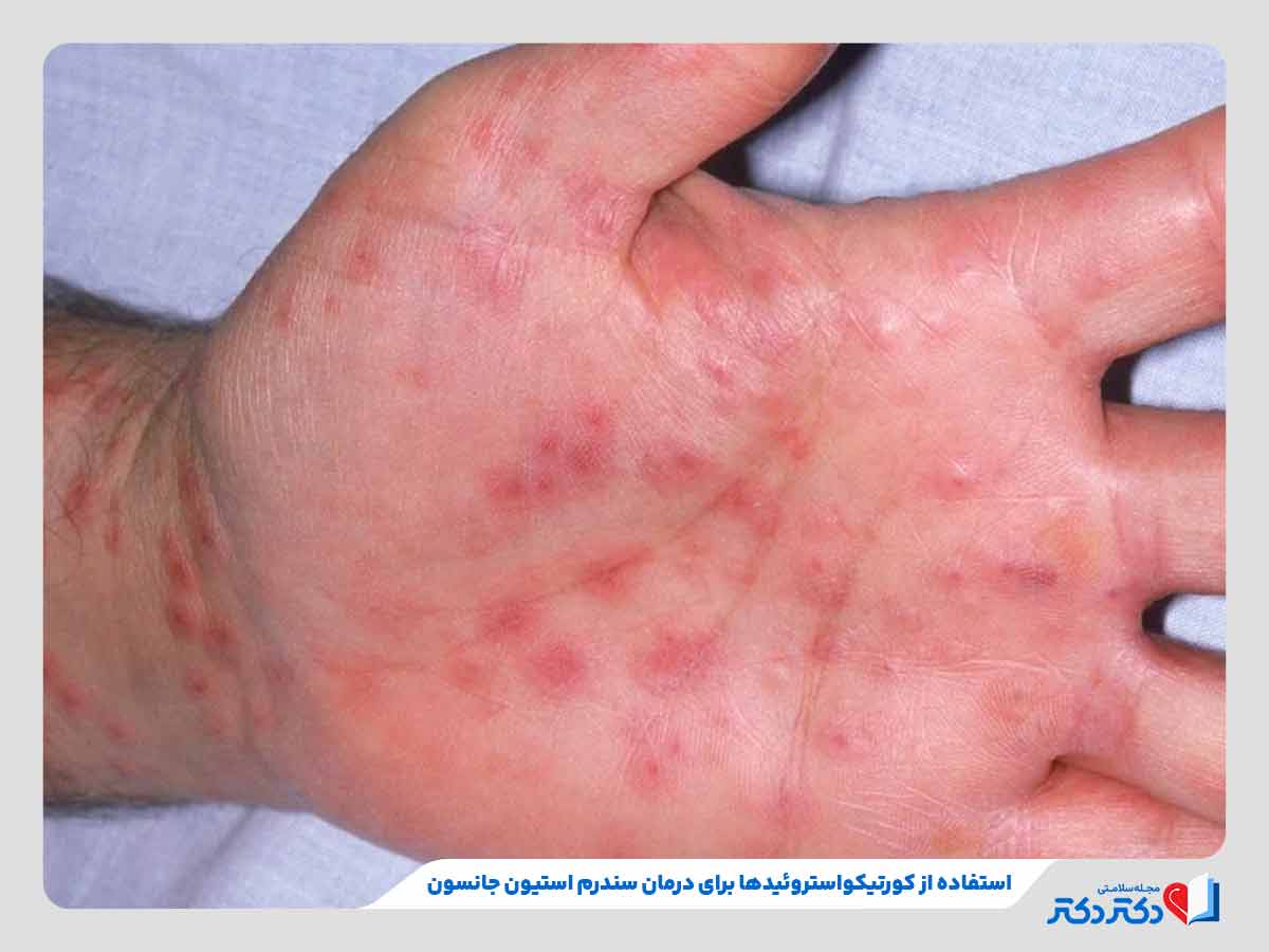 فرد نیازمند به درمان دارویی در اثر سندروم استیون جانسون