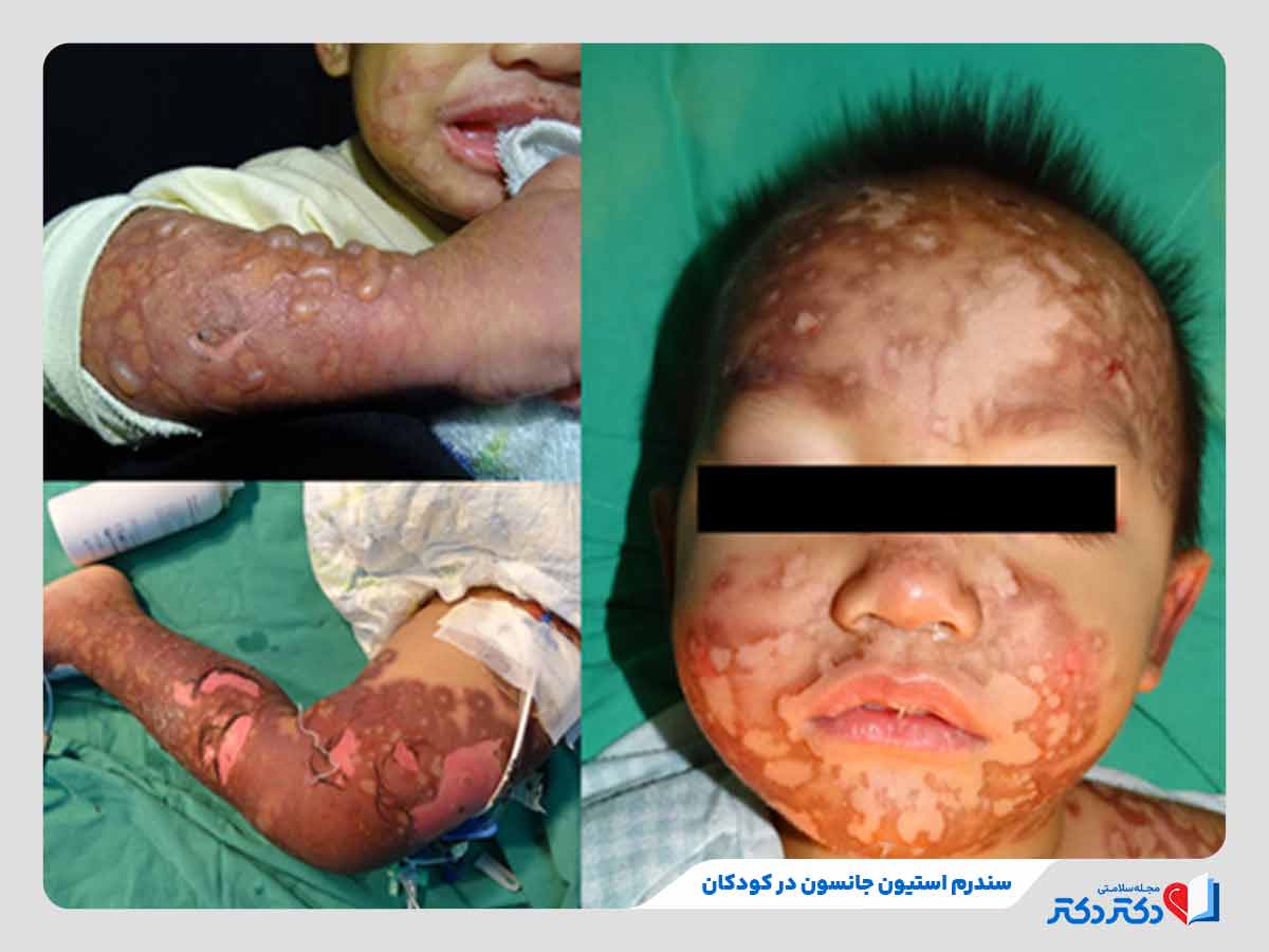 کودک مبتلا به سندروم استیون جانسون