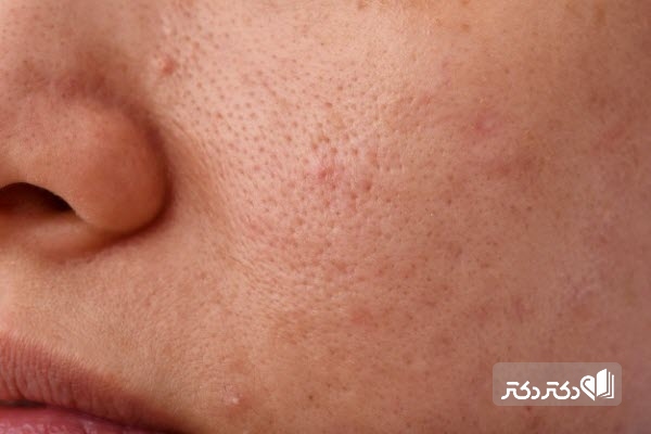 چگونه جوشهای سرسیاه پوستی را از بین ببریم؟
