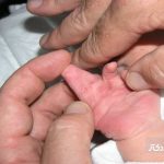 سین داکتیلی یا چسپیده بودن مادرزادی انگشتان دست و پا + راه‌های درمان