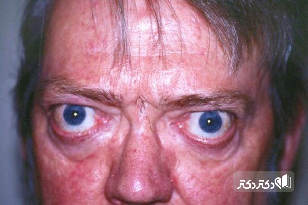 نشانه‌های بیماری گریوز چشمی