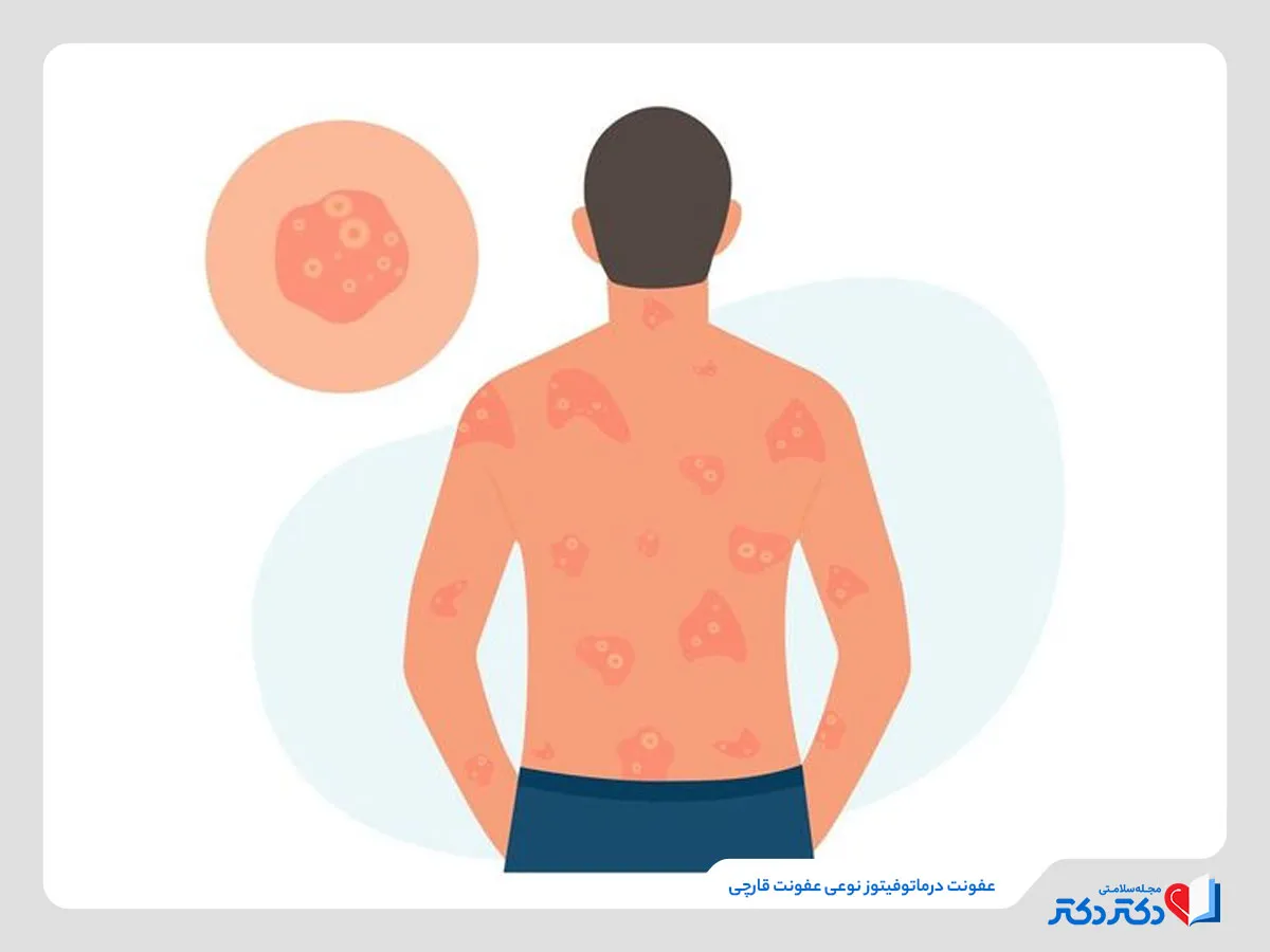 تینه آ کورپوریس؛ درماتوفیتوز تمام بدن