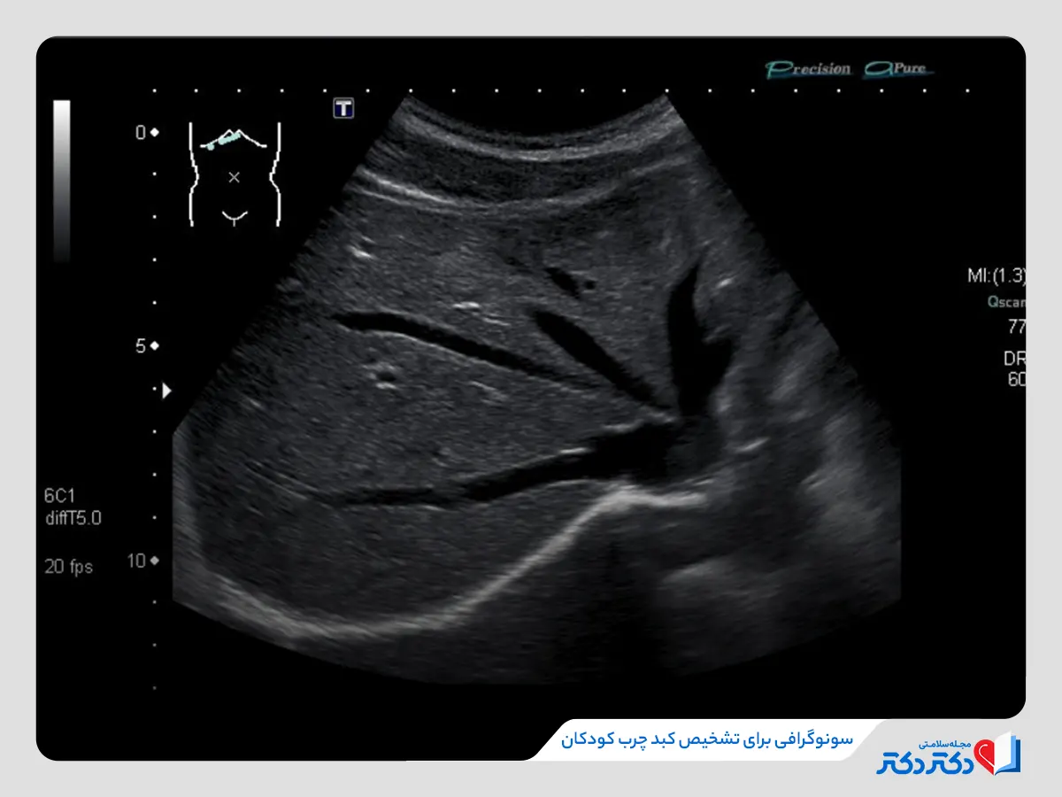 سونوگرافی و تشخیص کبد چرب در کودکان