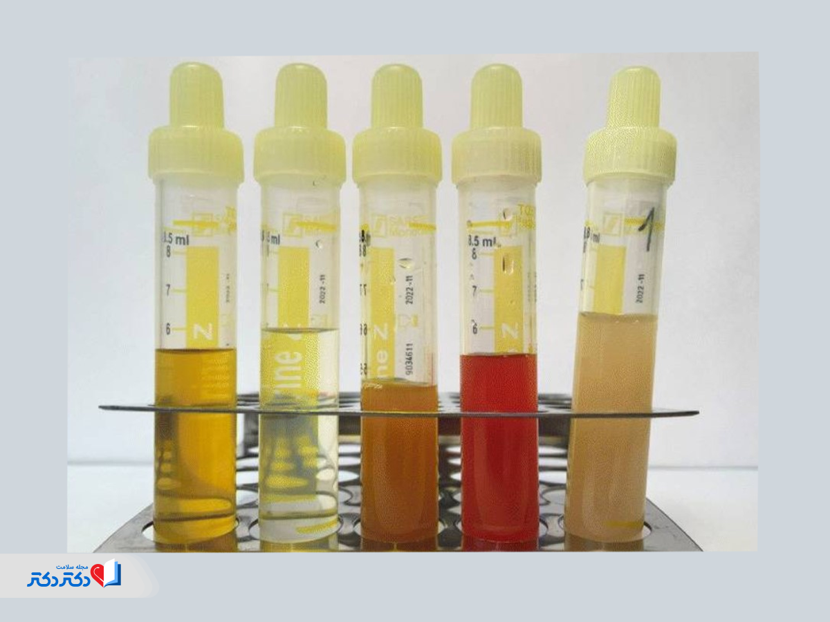 بررسی اسیدیته ادرار در آزمایش ادرار