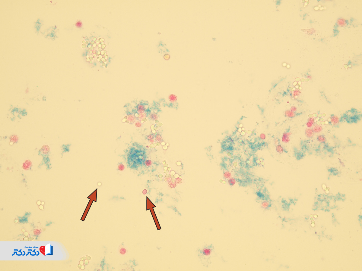 بررسی آزمایش میکروسکوپی ادرار 