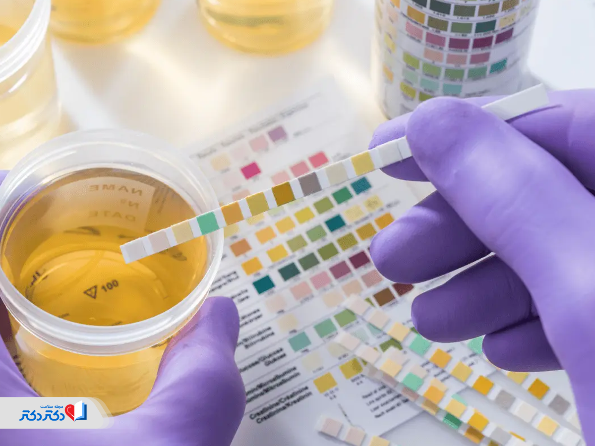 بررسی رنگ ادرار؛ در حالت طبیعی زرد کم‌رنگ تا کهربایی تیره