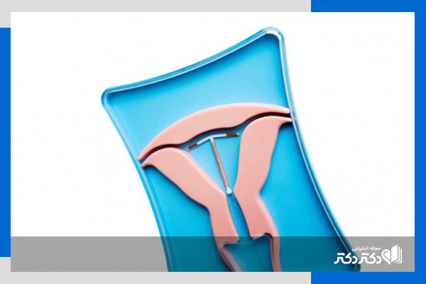 بهترین روش پیشگیری از بارداری در اوایل ازدواج