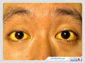 زردی چشم چیست و چرا در کودکان و بزرگسالان ایجاد می‌شود؟