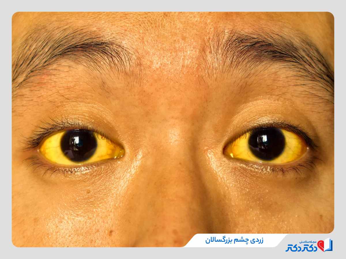 زردی چشl
