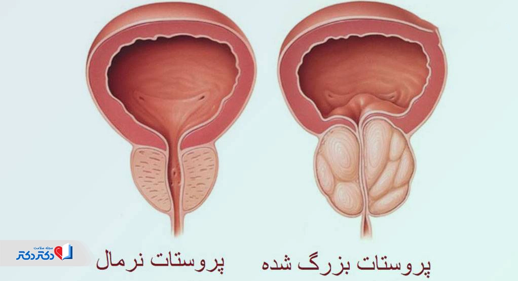 وجود خون در ادرار مردان