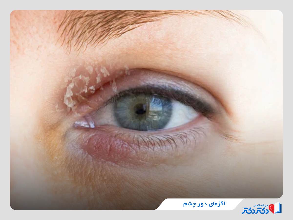 اگزمای دور چشم
