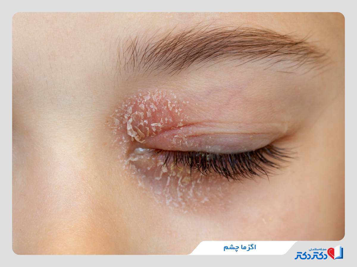 خشکی و پوسته‌پوسته‌شدن چشم 