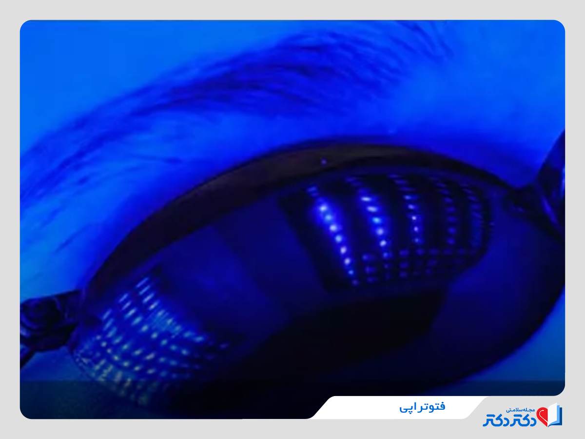 فتوتراپی برای درمان اگزمای چشم