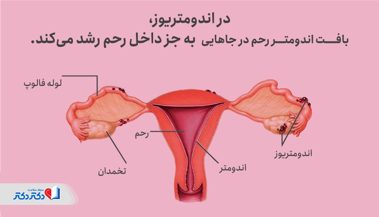 در اندومتریوز، بافت اندومتر در جاهایی به جز داخل رحم رشد میکند.