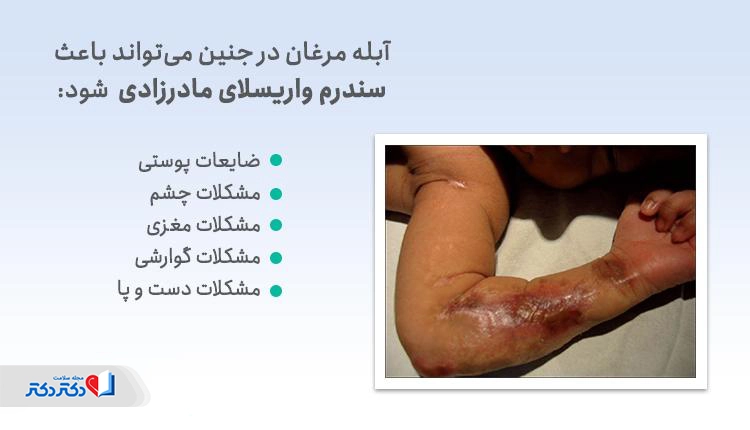 آبله مرغان در جنین میتواند باعث سندروم واریسلای مادرزادی شود.