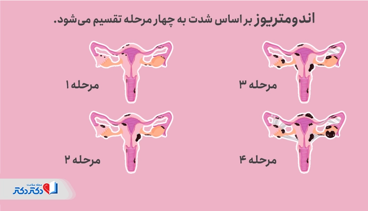 مراحل بیماری اندومتریوز