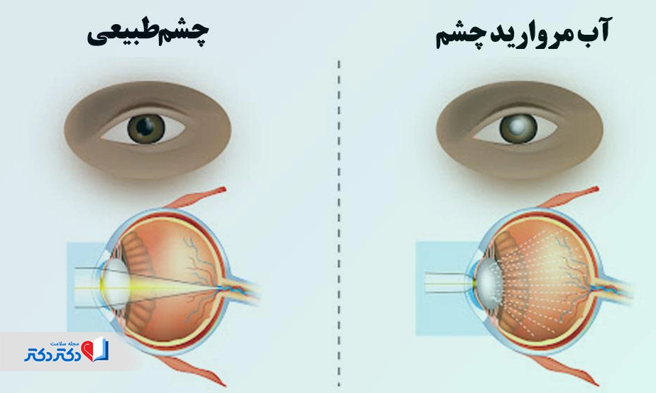 آب مروارید چشم