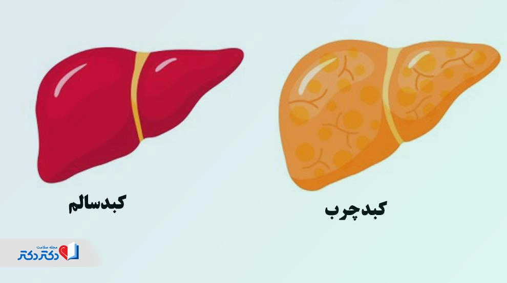 کبد چرب بارداری