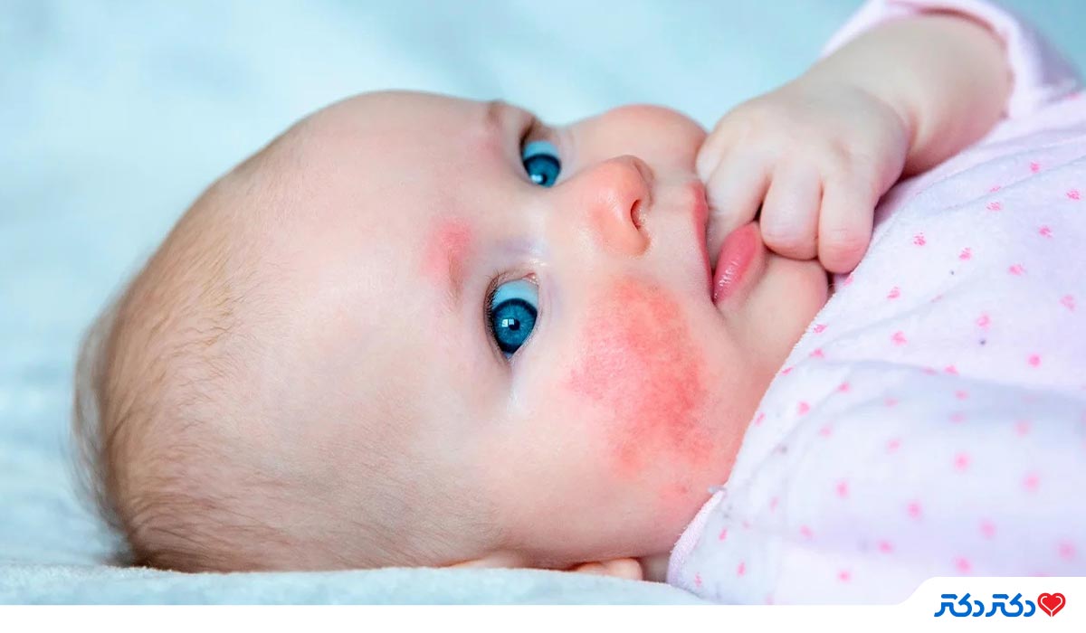 علائم آلرژی و حساسیت غذایی در نوزادان و کودکان نوپا 