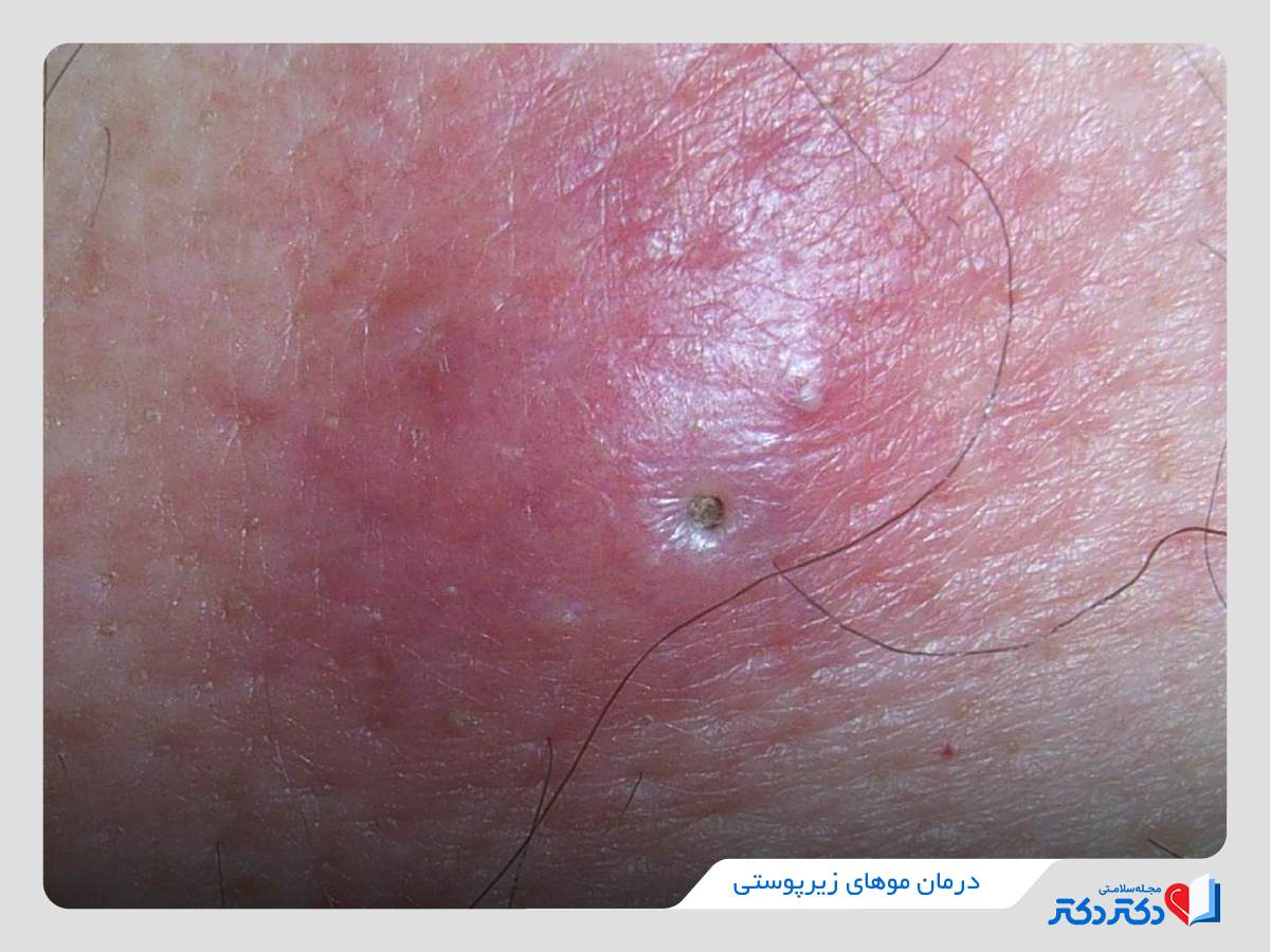 عفونت موی زیر پوستی 