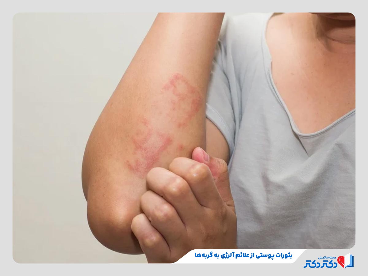 زن در حال خارش بثورات پوستی ناشی از آلرژی به گربه ها