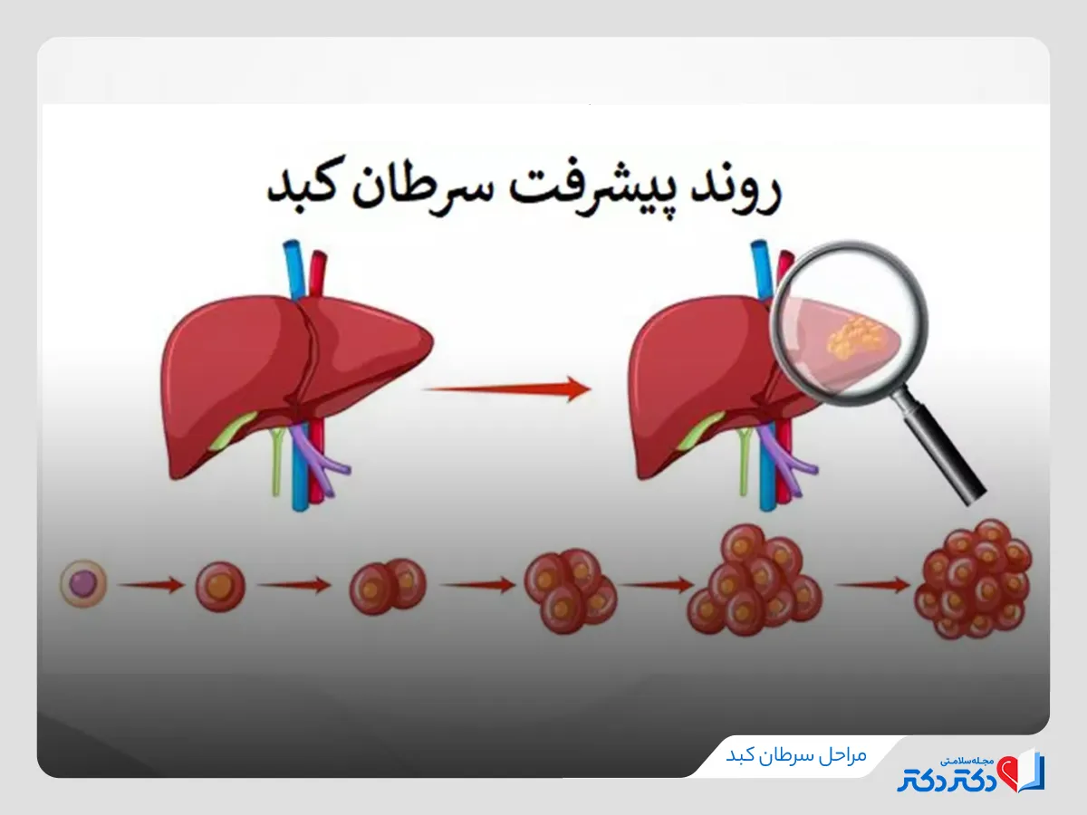 مراحل پیشرفت سرطان کبد