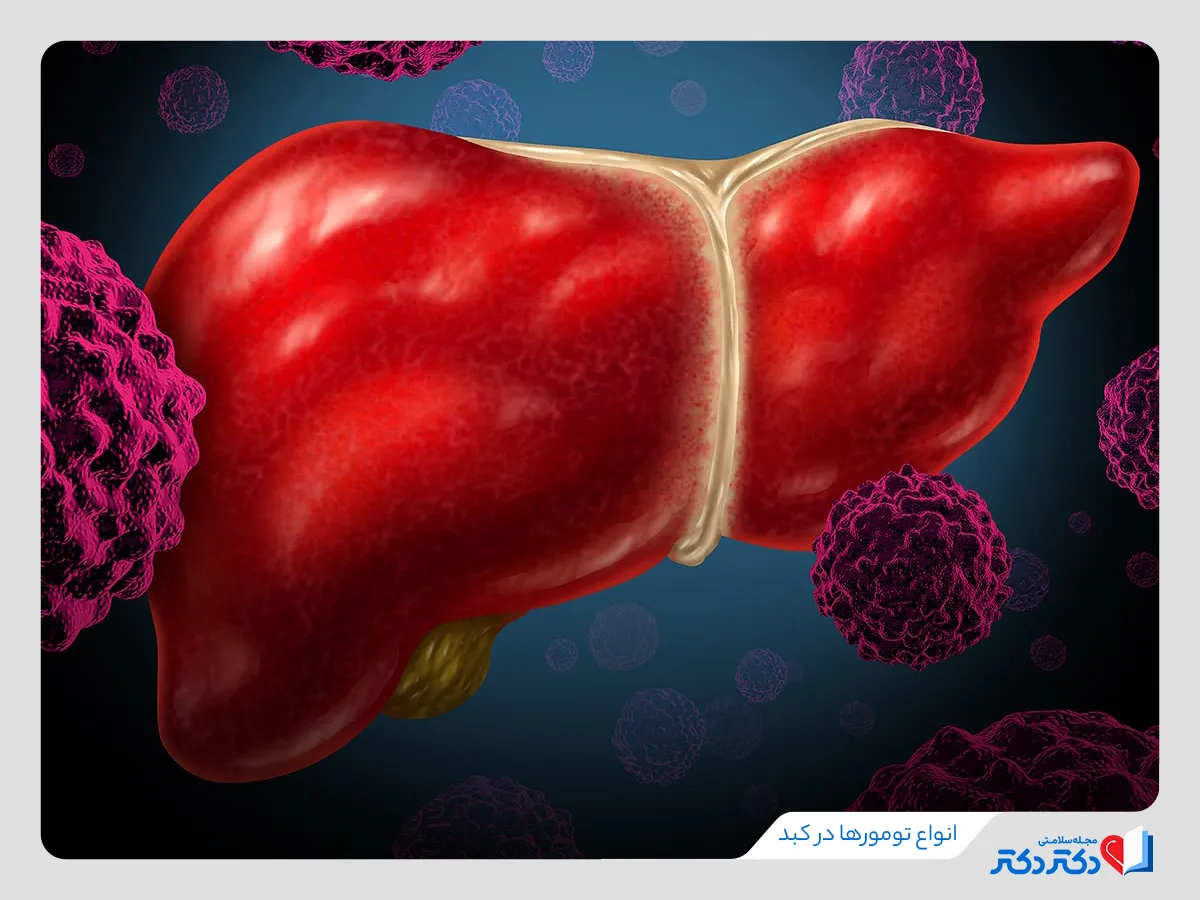 تومورهای خوش خیم وبد خیم سرطان کبد