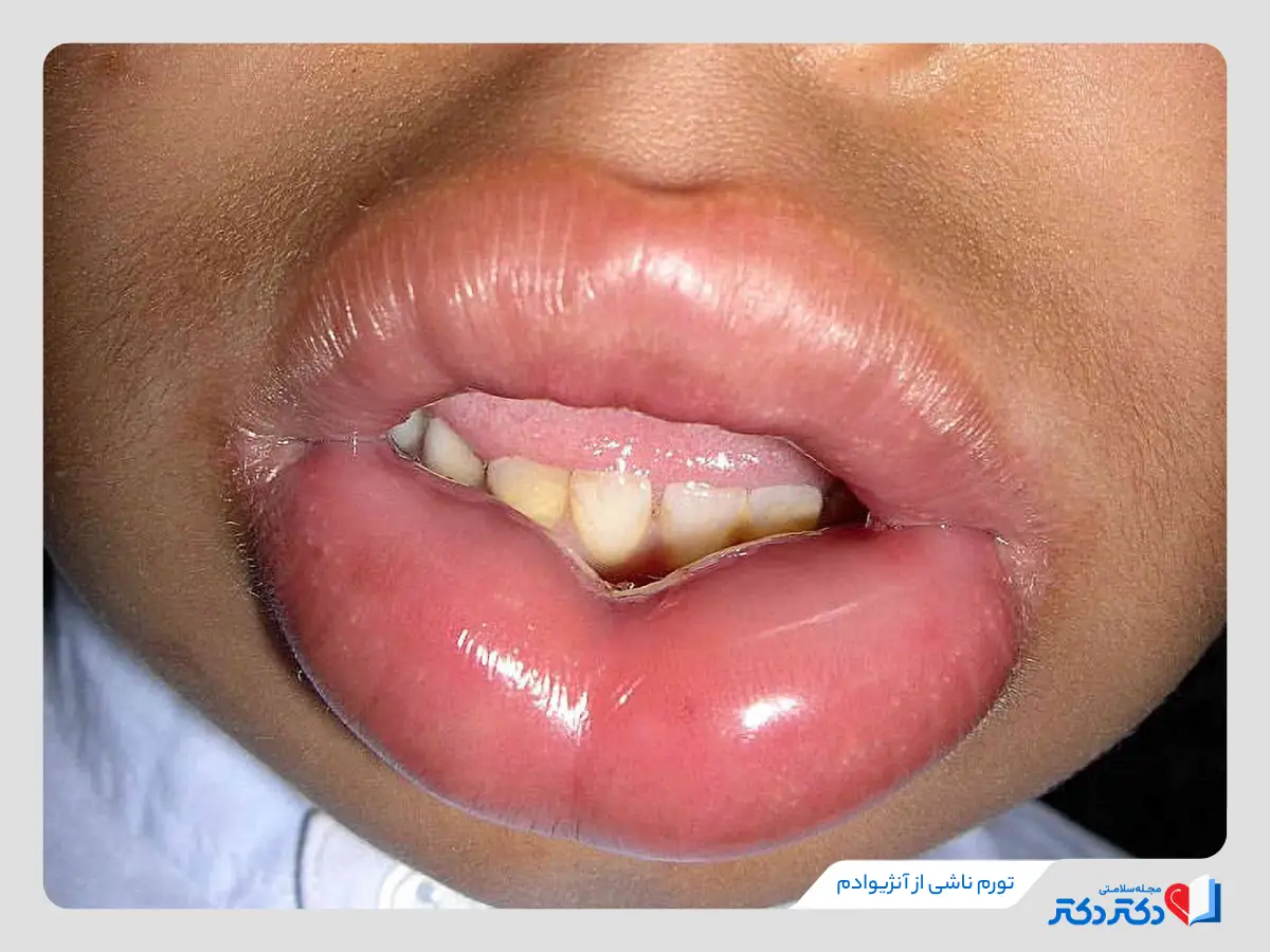 آنژیوادم با تورم لب ها، خارش، سوزش و درد در ناحیه تورم همراه است